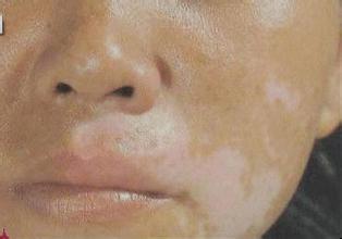 你知道口腔黏膜白癜风吗